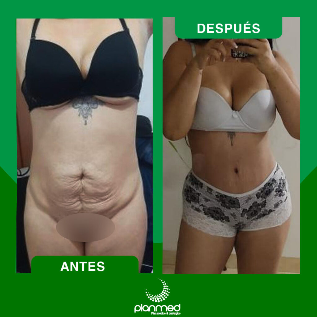 FINANCIACION CIRUGIA PLASTICA ANTES Y DESPUES, APROBADO, CREDITO, AHORRO, ABDOMINOPLASTIA, LIPOABDOMINOPLASTIA, PRESTAMOS, FINANCIADO