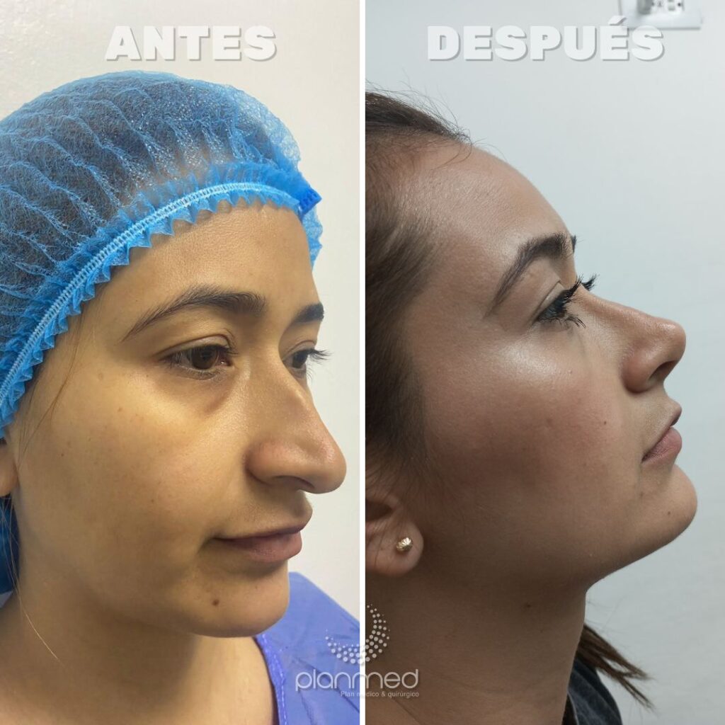 CREDITO, CUOTAS, AHORRO, FINANCIACION, CIRUGIA PLASTICA, MEDELLIN, CALI, COLOMBIA, PRESTAMO, BANCO, COOPERATIVA, RINOPLASTIA