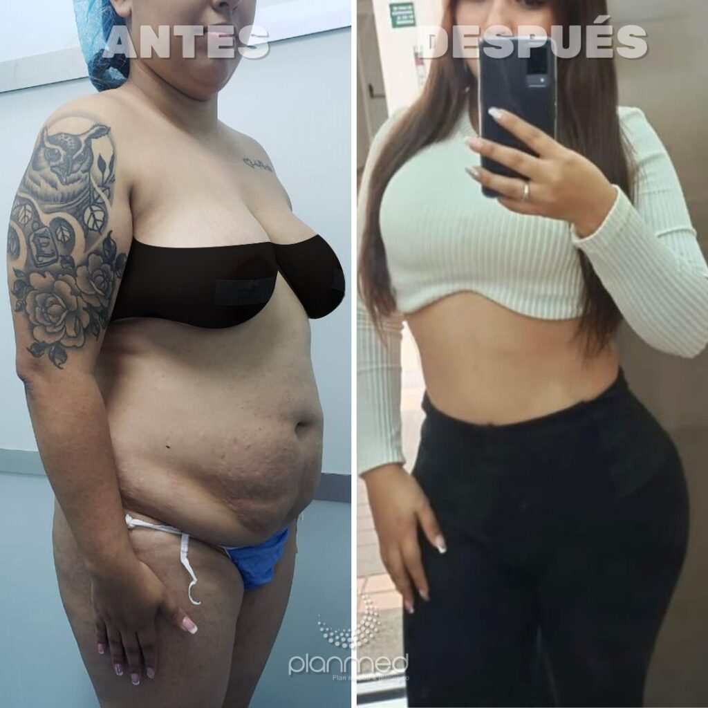 CREDITO, CUOTAS, AHORRO, FINANCIACION, CIRUGIA PLASTICA, MEDELLIN, CALI, COLOMBIA, PRESTAMO, BANCO, COOPERATIVA, LIPOABDOMINOPLASTIA, ABODMINOPLASTIA, LIPOTRANSFERENCIA