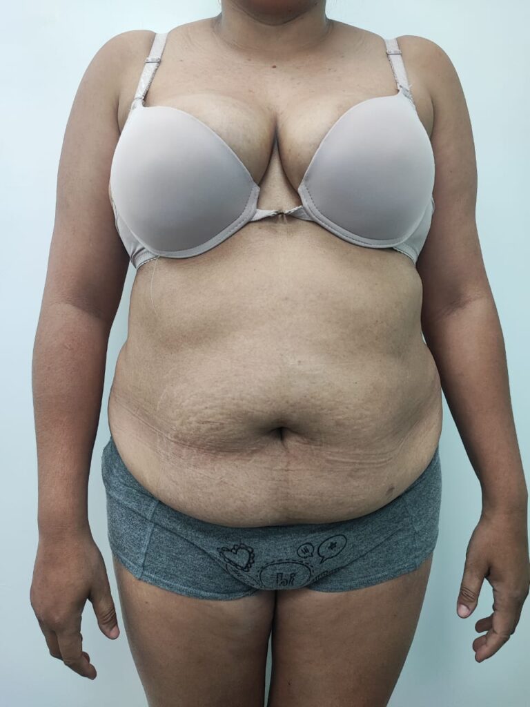 FINANCIACION CIRUGIA PLASTICA, LIPOABDOMINOPLASTIA ANTES Y DESPUES CIRUGIA PLASTICA, FINANCIACION, PLANMED, MEDELLIN, CALI