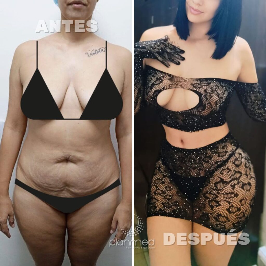 FINANCIACION CIRUGIA PLASTICA, LIPOABDOMINOPLASTIA ANTES Y DESPUES CIRUGIA PLASTICA, FINANCIACION, PLANMED, MEDELLIN, CALI