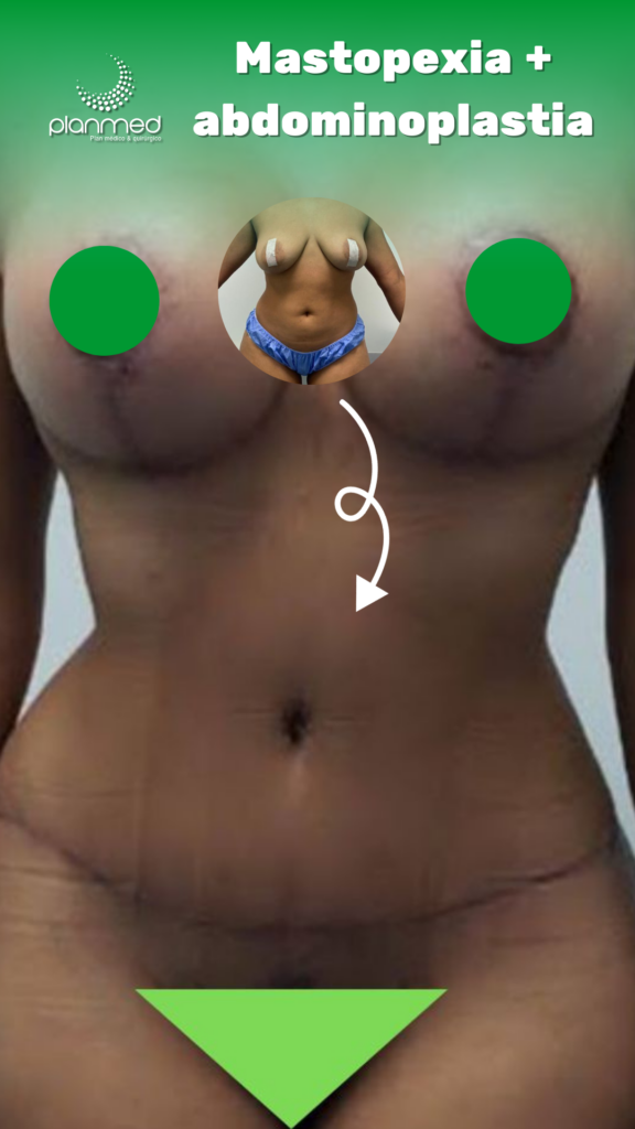 FINANCIACION, FINANCIACION CIRUGIA PLASTICA, MASTOPEXIA, LIPOABDOMINOPLASTIA, CIRUGIA, CIRUGIA PLASTICA, CREDITO, AHORRO