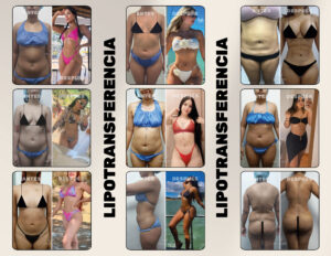 FINANCIACION CIRUGIA PLASTICA LIPOABDOMINOPLASTIA, ABDOMINOPLASTIA, LIPOTRANSFERENCIAFINANCIERA, COOPERATIVA, ENTIDAD AHORRO, CREDITO, APROBADO