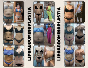 FINANCIACION CIRUGIA PLASTICA LIPOABDOMINOPLASTIA, ABDOMINOPLASTIA, LIPOTRANSFERENCIAFINANCIERA, COOPERATIVA, ENTIDAD AHORRO, CREDITO, APROBADO