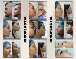FINANCIACION CIRUGIA PLASTICA LIPOABDOMINOPLASTIA, ABDOMINOPLASTIA, LIPOTRANSFERENCIAFINANCIERA, COOPERATIVA, ENTIDAD AHORRO, CREDITO, APROBADO