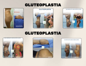 FINANCIACION CIRUGIA PLASTICA LIPOABDOMINOPLASTIA, ABDOMINOPLASTIA, LIPOTRANSFERENCIAFINANCIERA, COOPERATIVA, ENTIDAD AHORRO, CREDITO, APROBADO