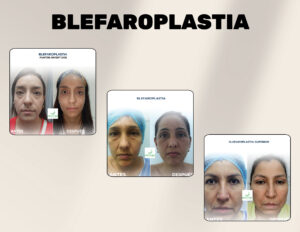 FINANCIACION CIRUGIA PLASTICA LIPOABDOMINOPLASTIA, ABDOMINOPLASTIA, LIPOTRANSFERENCIAFINANCIERA, COOPERATIVA, ENTIDAD AHORRO, CREDITO, APROBADO