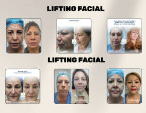 FINANCIACION CIRUGIA PLASTICA LIPOABDOMINOPLASTIA, ABDOMINOPLASTIA, LIPOTRANSFERENCIAFINANCIERA, COOPERATIVA, ENTIDAD AHORRO, CREDITO, APROBADO