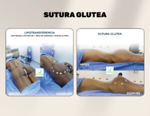FINANCIACION CIRUGIA PLASTICA LIPOABDOMINOPLASTIA, ABDOMINOPLASTIA, LIPOTRANSFERENCIAFINANCIERA, COOPERATIVA, ENTIDAD AHORRO, CREDITO, APROBADO