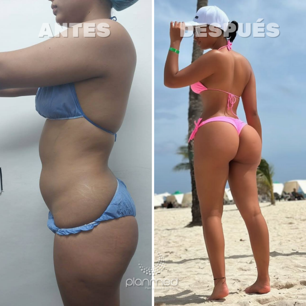 FINANCIACION CIRUGIA PLASTICA, LIPOABDOMINOPLASTIA ANTES Y DESPUES CIRUGIA PLASTICA, FINANCIACION, PLANMED, MEDELLIN, CALI